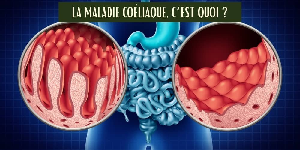 intolérance au gluten, maladie coeliaque, dommages sur la paroi intestinale